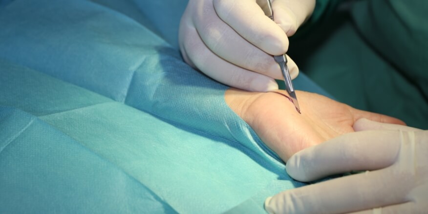 عملية جراحة عصب اليد